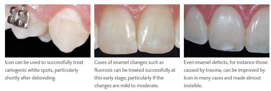 Icon Karies Infiltrant Smooth Surface Ekonomifp