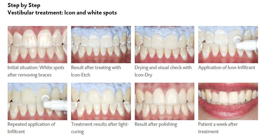 Icon Karies Infiltrant Smooth Surface Ekonomifp