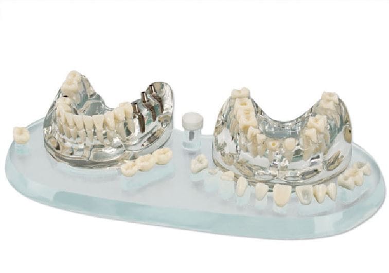 Studiemodell transparent Implantat 1:1 ÖK/UK