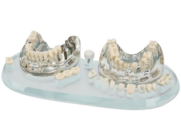 Studiemodell transparent Implantat 1:1 ÖK/UK