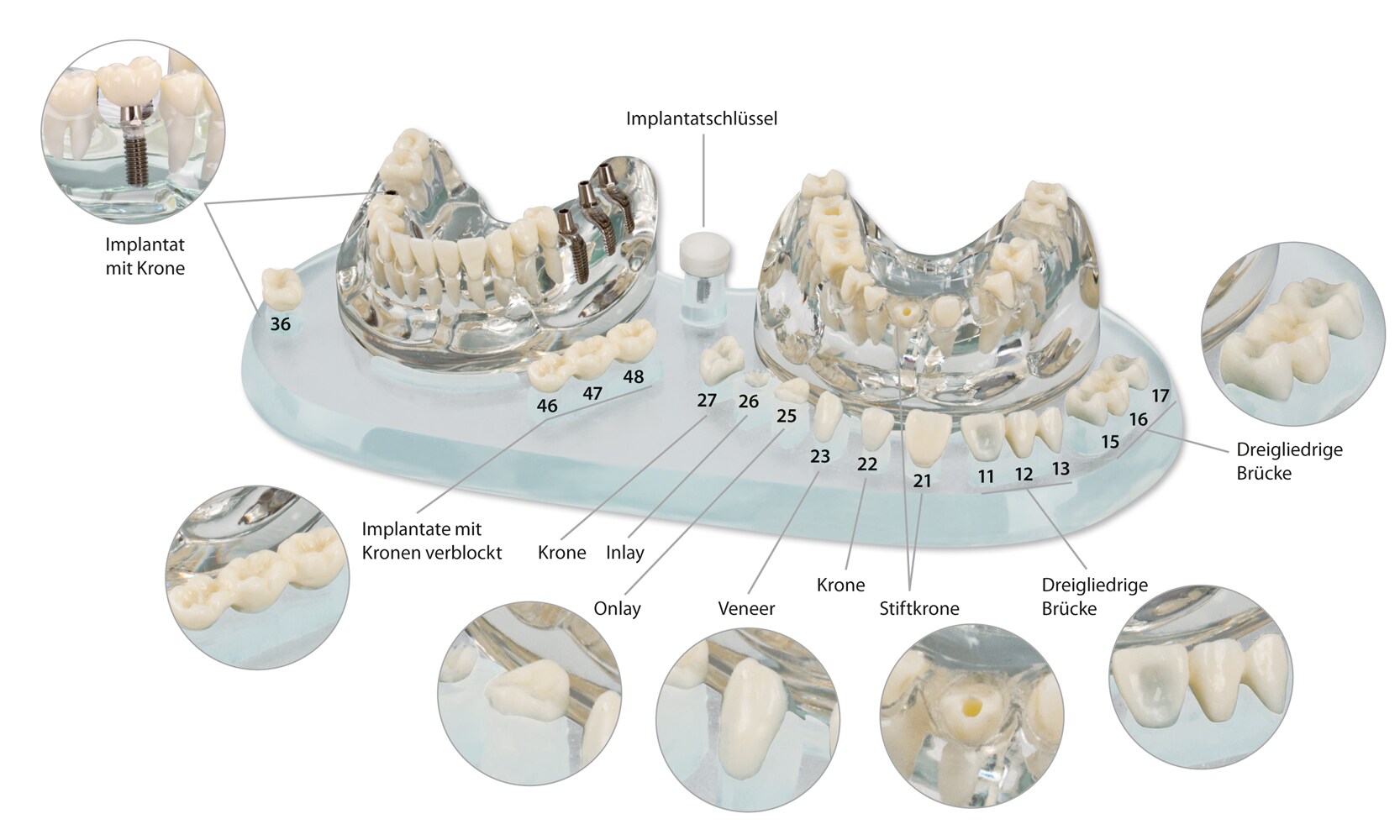 Studiemodell transparent Implantat 1:1 ÖK/UK