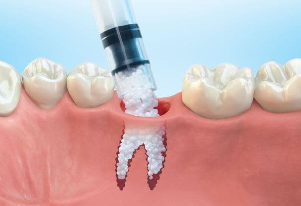GUIDOR easy-graft CLASSIC+ 400 1x0,4ml