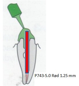 ParaPost XP Avtryckstift 1,25mm röd P743-5 20st